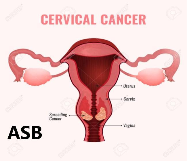 Soigner le cancer du col de l'uterus avec les plantes