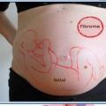 Fibrome myome grossesse