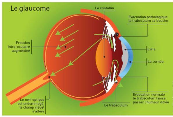 Maladie Chronique: Glaucome Traitement Naturel