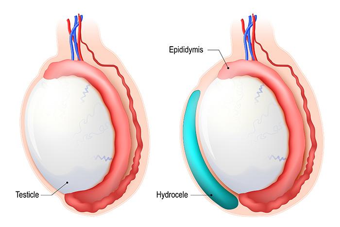 Hydrocele