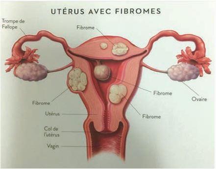 Uterus avec fibrome
